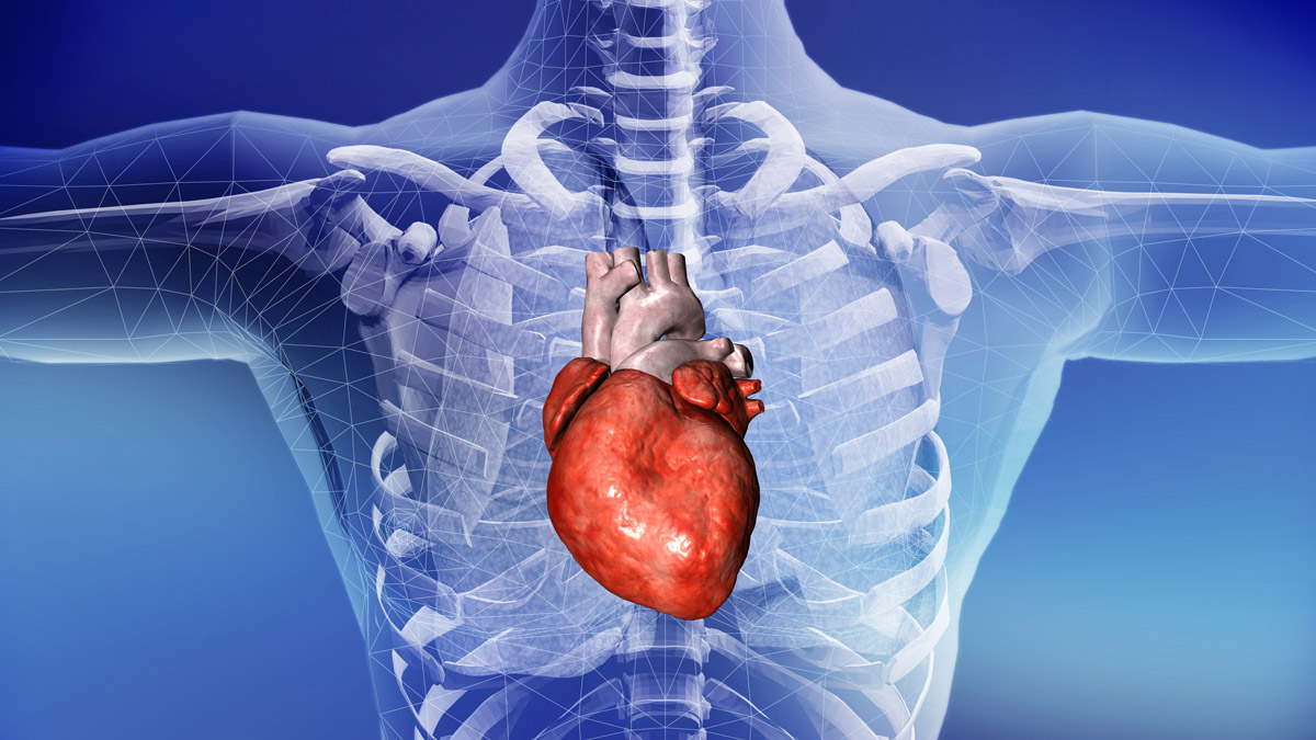 Infarto del miocardio